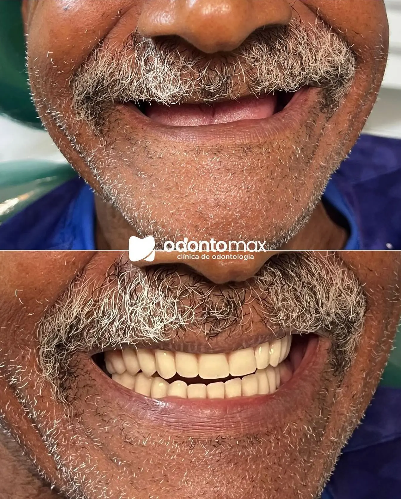 Alinhamento com Aparelho Ortodôntico — Antes e Depois na Odontomax