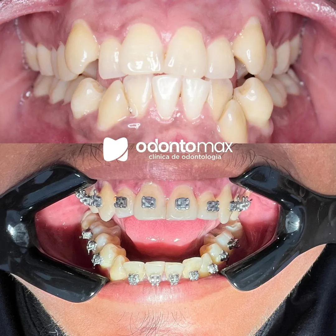 Reabilitação Protética Total do Sorriso — Antes e Depois na Odontomax