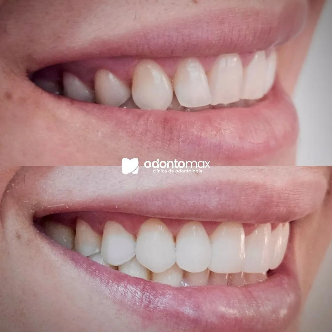 Facetas em Resina e Harmonização — Antes e Depois na Odontomax