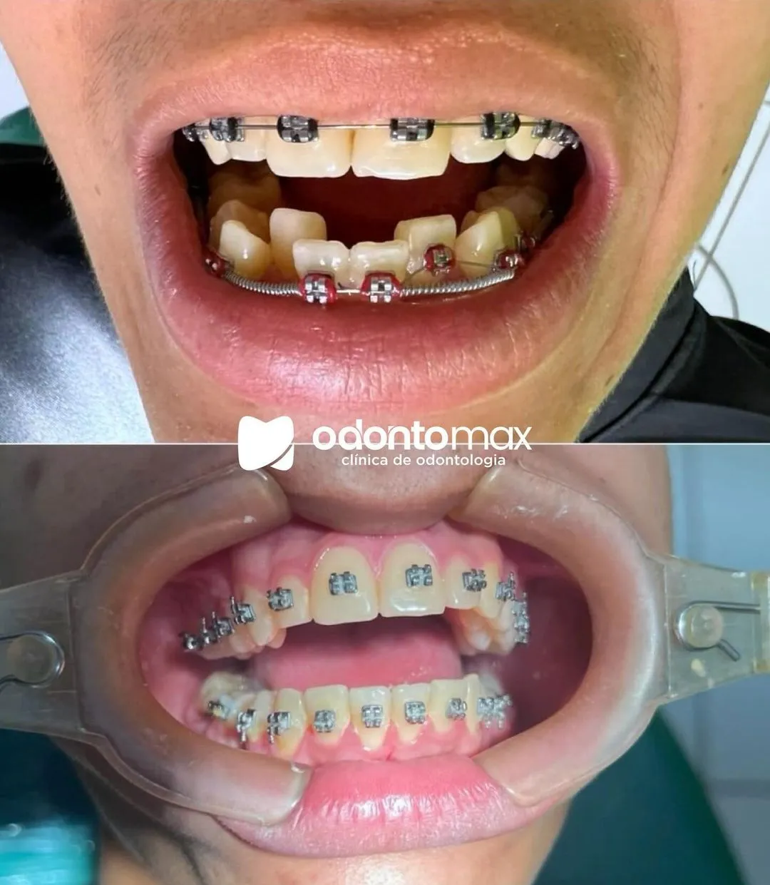 Restauração Estética e Clareamento — Antes e Depois na Odontomax