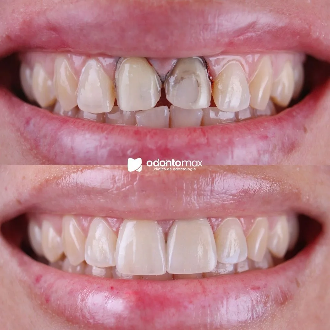 Remoção de Tártaro e Saúde Gengival — Antes e Depois na Odontomax