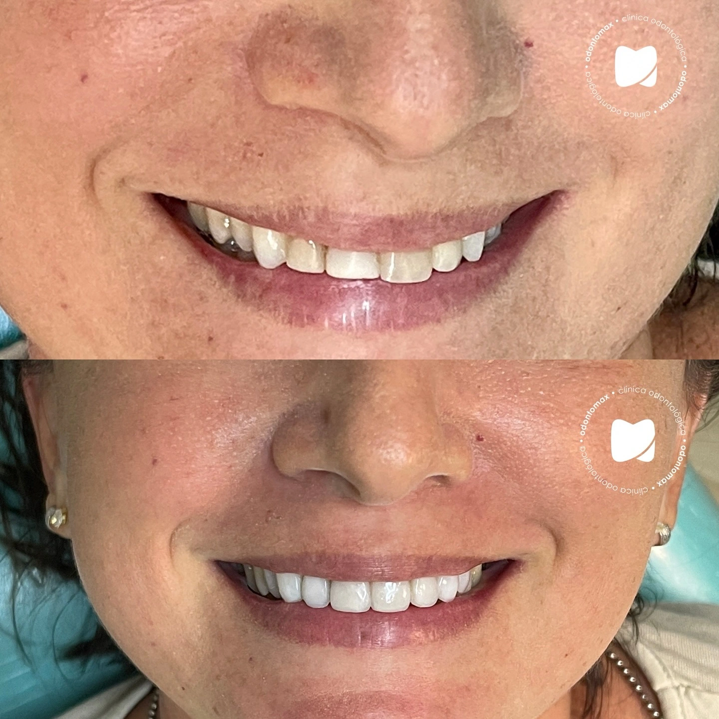 Correção de Espaçamento (Diastema) — Antes e Depois na Odontomax