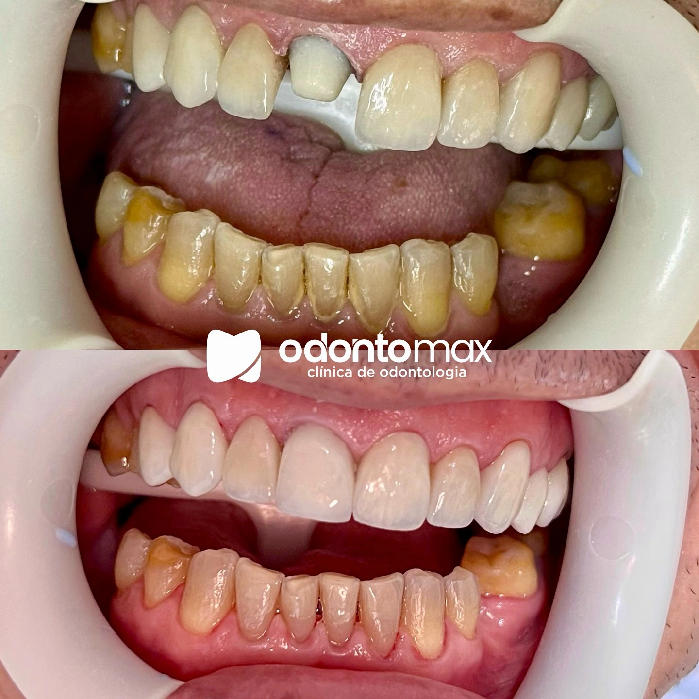 Harmonização do Sorriso com Resinas — Antes e Depois na Odontomax