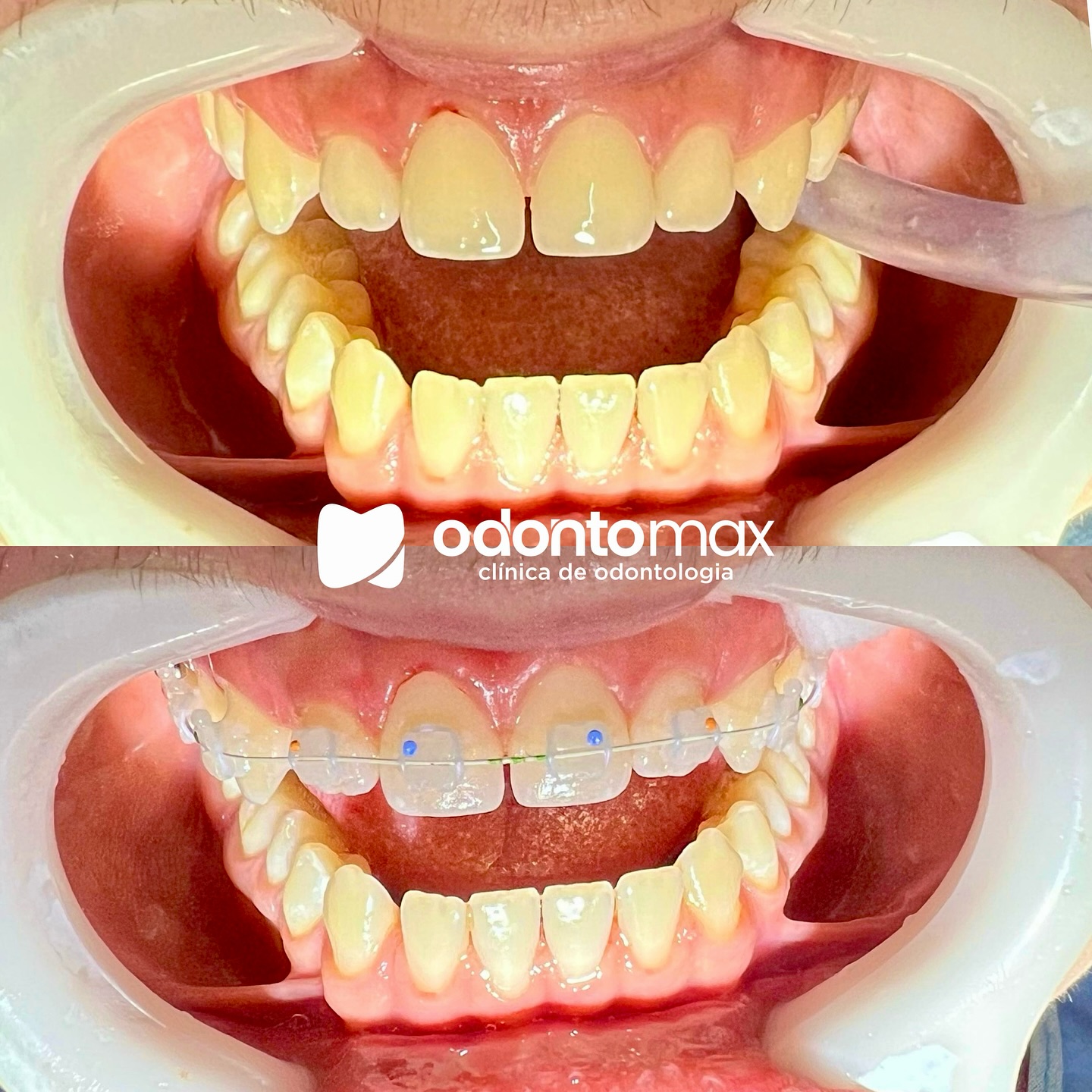 Tratamento Periodontal e Limpeza — Antes e Depois na Odontomax