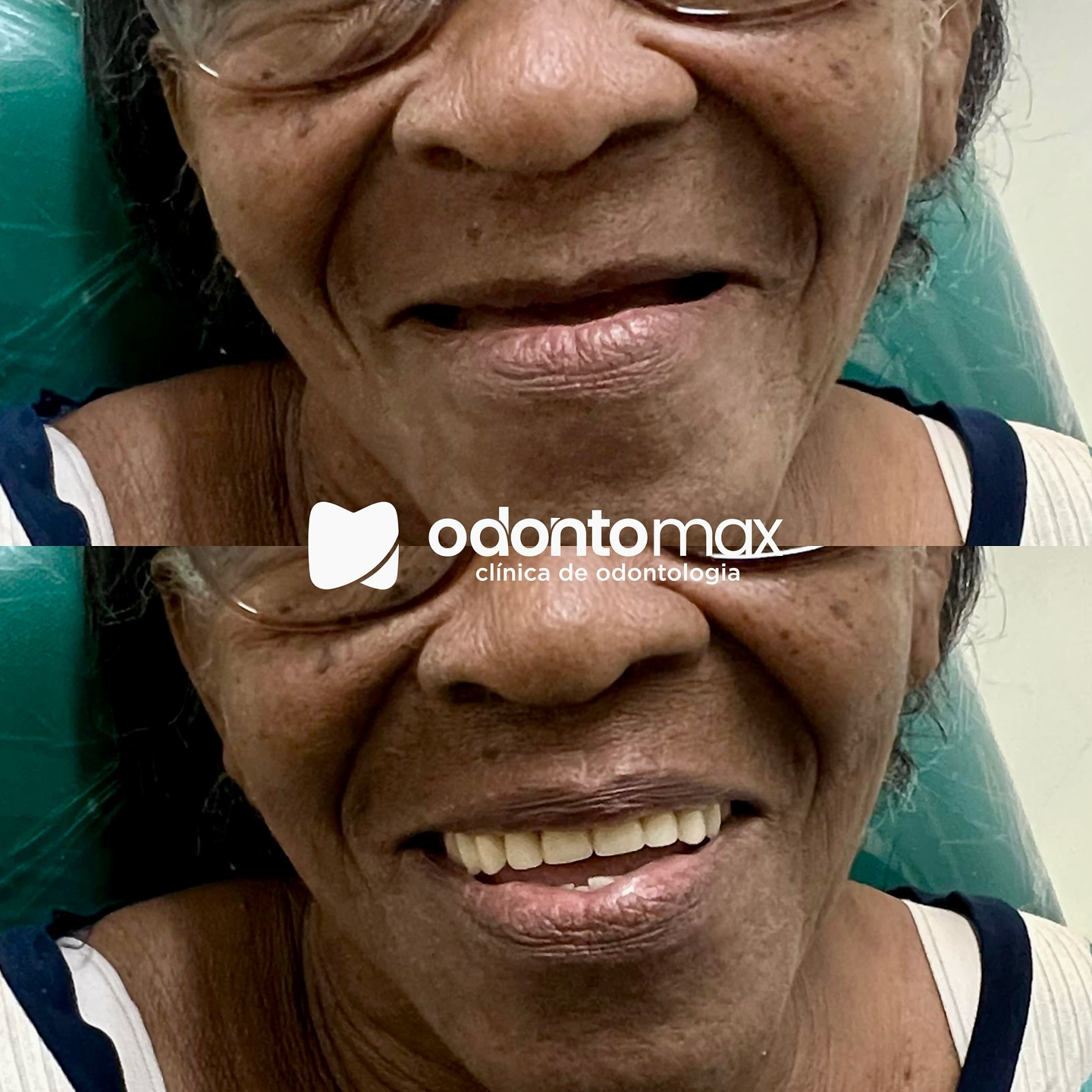 Reabilitação Funcional Posterior — Antes e Depois na Odontomax