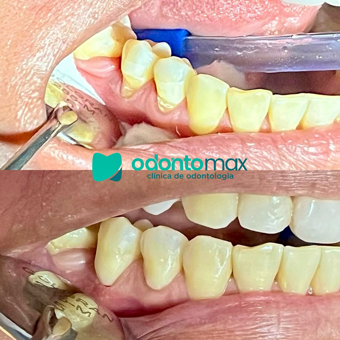 Clareamento Dental e Acabamento — Antes e Depois na Odontomax